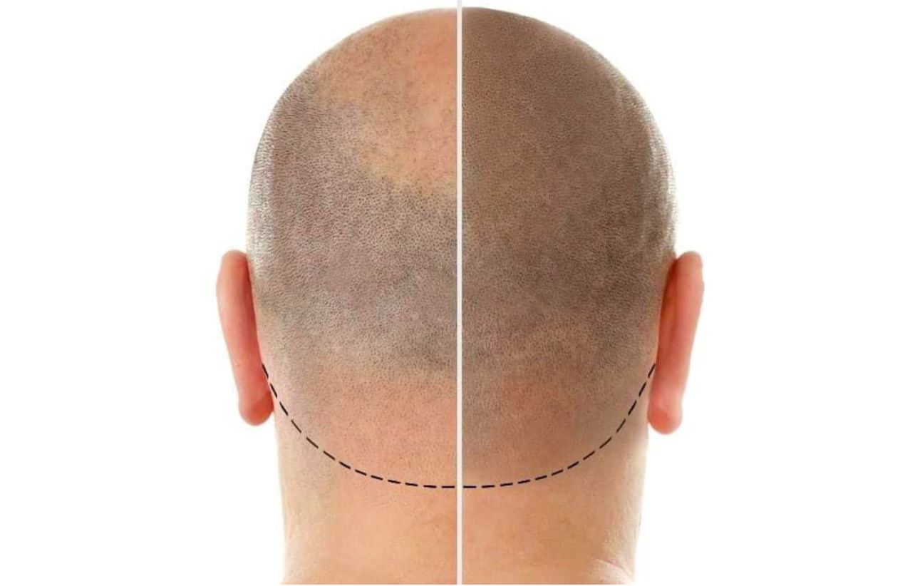 SMP Scalp Micropigmentation