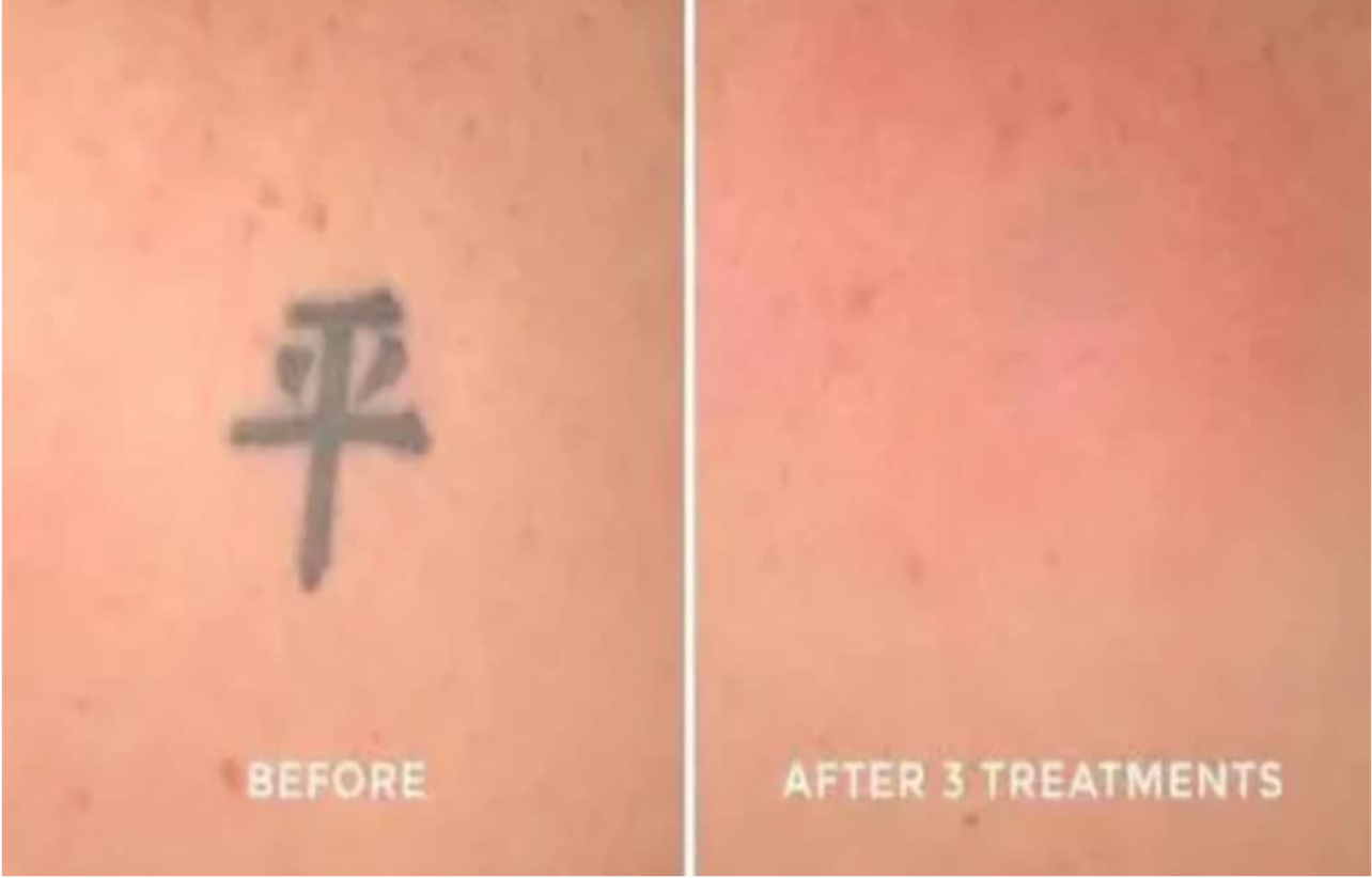 Pigmentation and Tattoo Removal