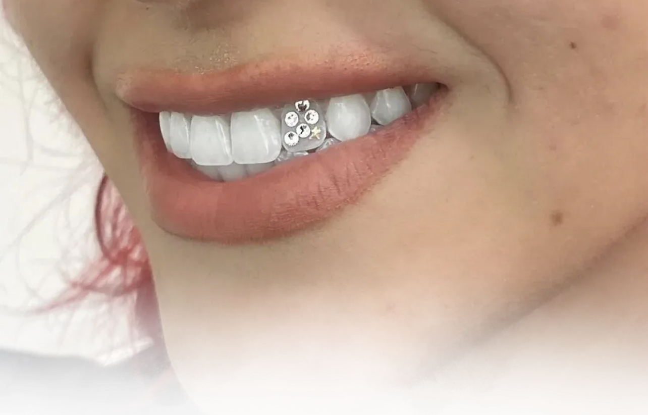 Dental Gemming